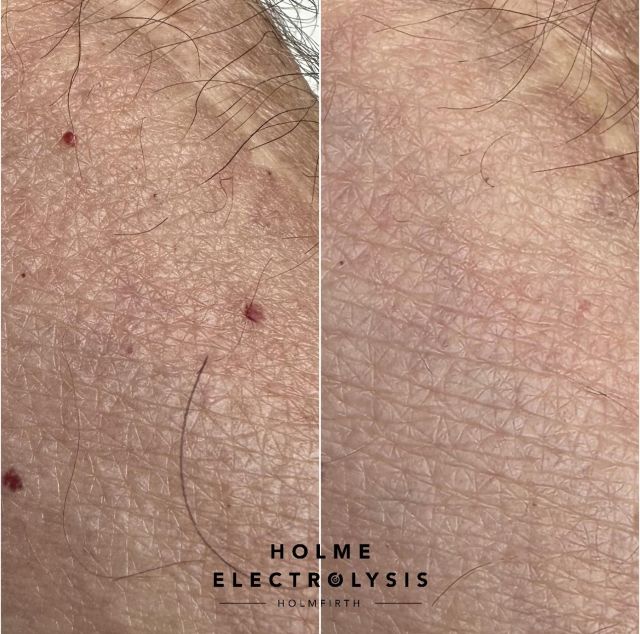 Socials HolmeElectrolysis